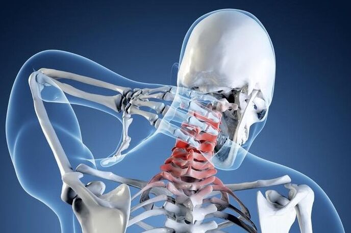 Osteohondroza 1. stopnje