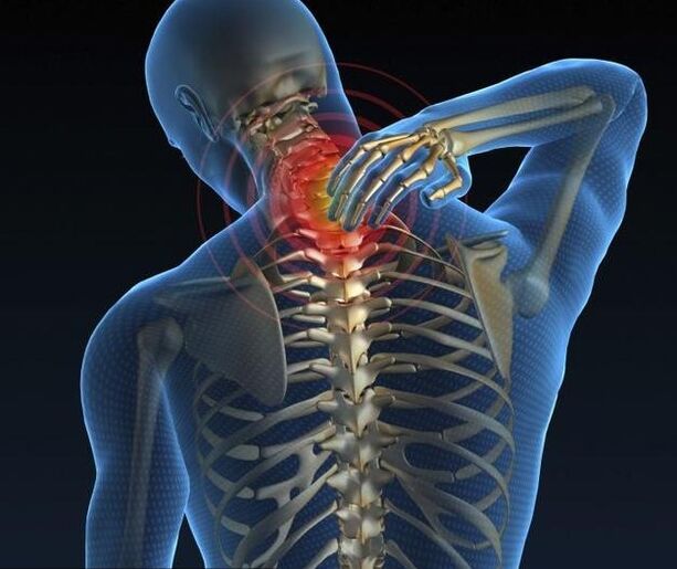 Osteohondroza materničnega vratu