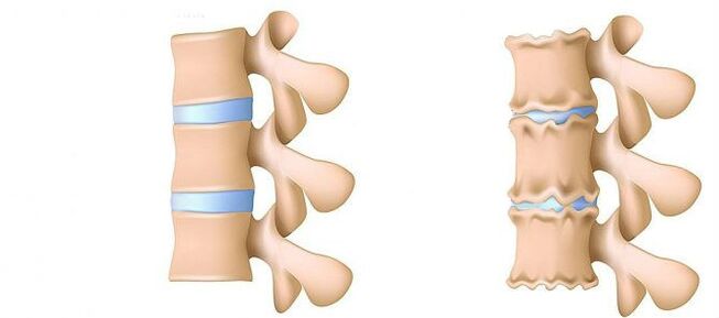 Osteohondroza ledvenega območja